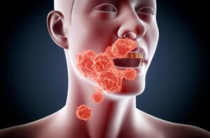 Cancer-oral