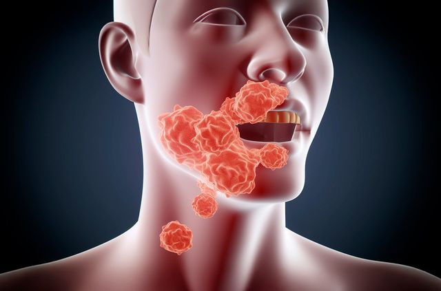 Cancer-oral